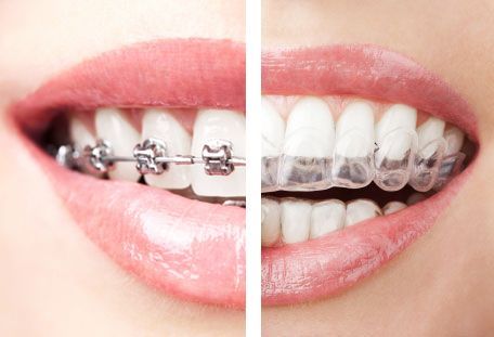 Braces & Aligners